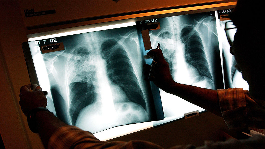 2 active tuberculosis cases traced to San Francisco strip club — KTVU FOX 2 Bay Area, San Mateo Health news